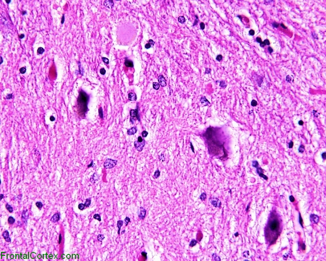 Progressive supranuclear palsy, dentate nucleus of cerebellum, H. and E. stain x 200